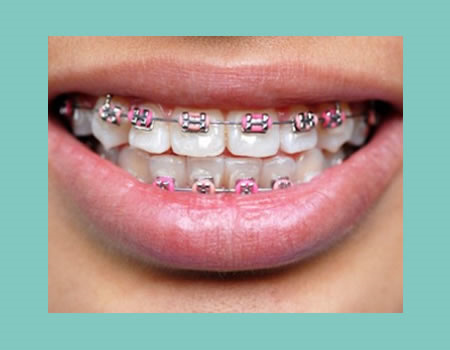 apparecchi fissi - prestazioni di ortodonzia