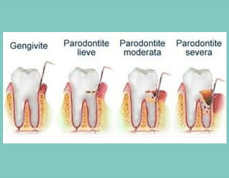 evoluzione parodontologia